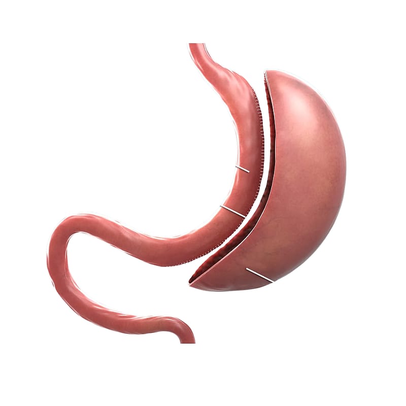 Diagram of a sleeve gastrectomy: the stomach stapled into a narrow sleeve shape.